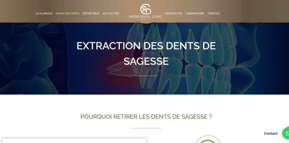 Quand faut-il extraire les dents de sagesse ? Quand faut-il extraire les dents de sagesse ?