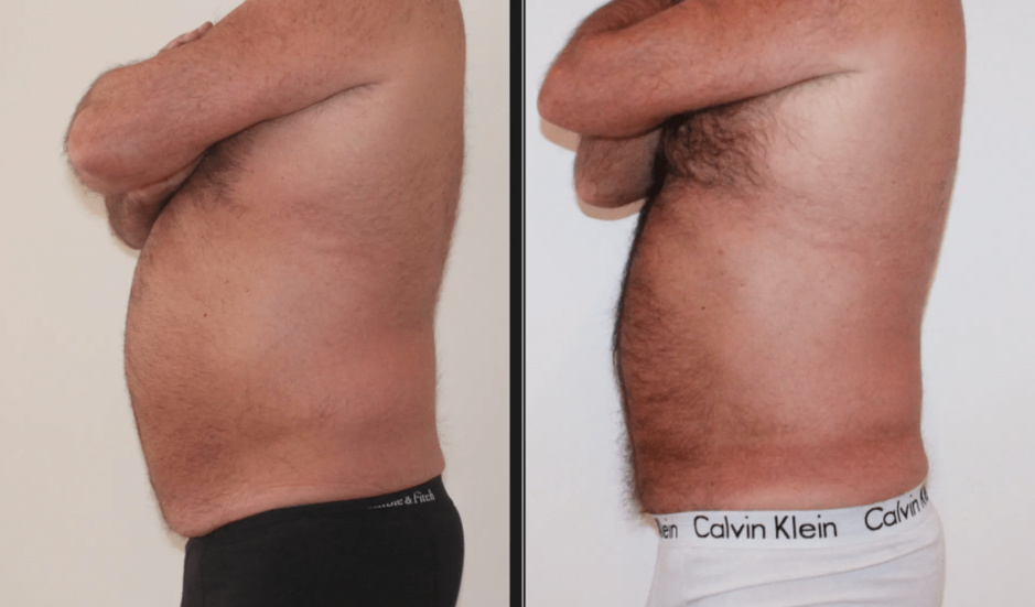 Liposuccion à Genève, le Dr Xavier Tenorio répond à nos questions Liposuccion à Genève, le Dr Xavier Tenorio répond à nos questions