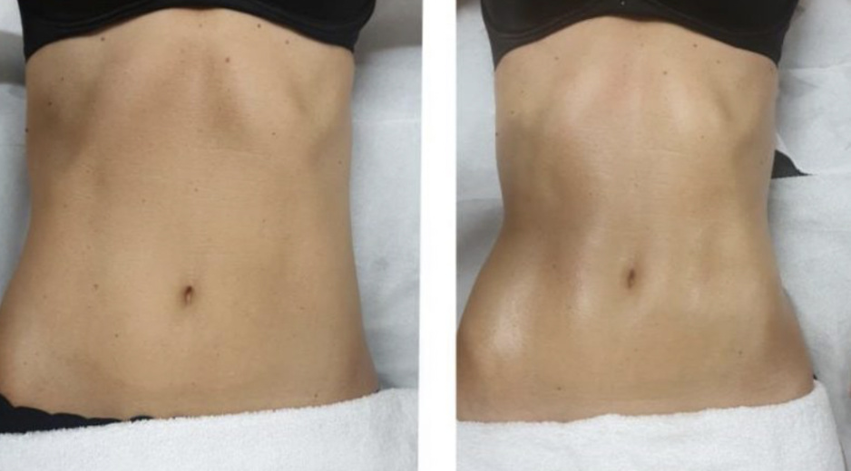 Abdominoplastie Genève, Dr Xavier Tenorio expert et spécialiste Abdominoplastie Genève, Dr Xavier Tenorio expert et spécialiste