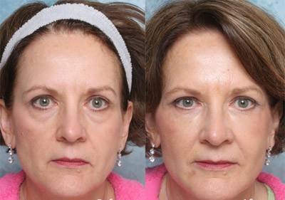 Fillers volume du visage Genève, le Dr Grept Locher nous en parle ouvertement Fillers volume du visage Genève, le Dr Grept Locher nous en parle ouvertement